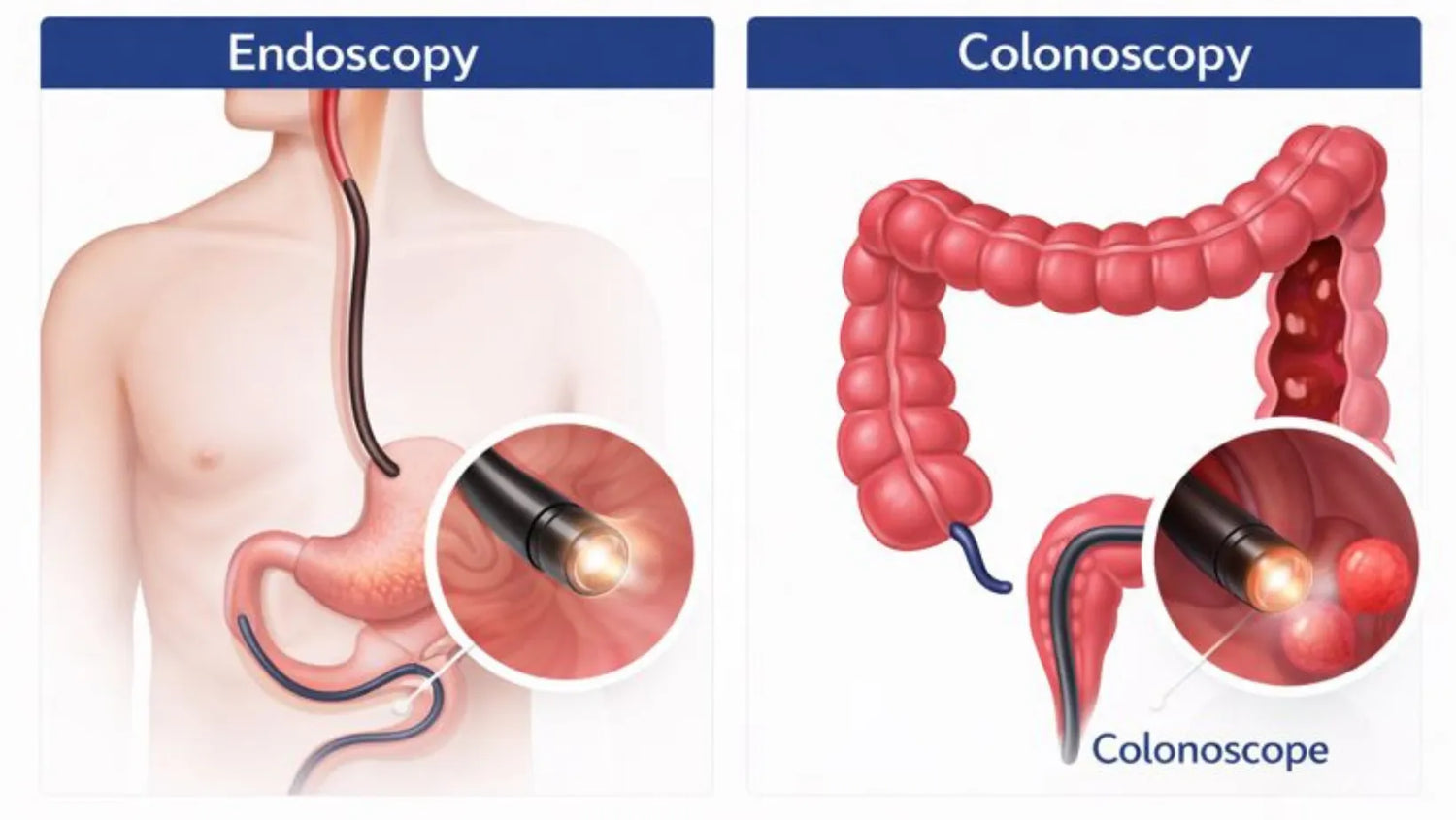 Endoscopy VS Colonoscopy : Know The Difference from the best colorectal Surgron in surat