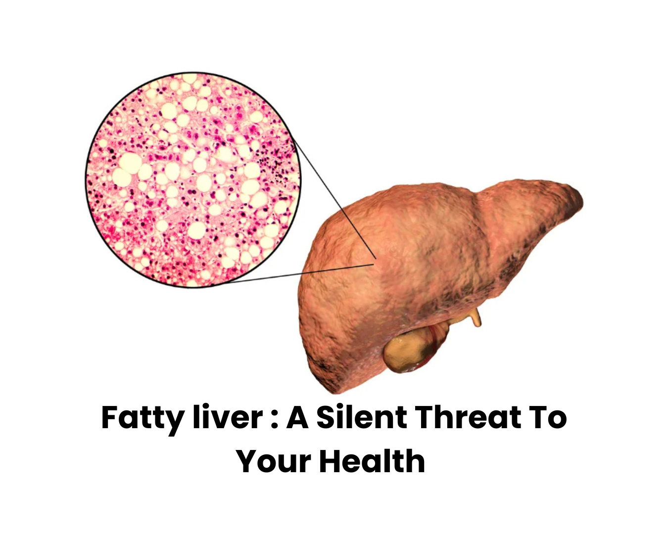 Fatty liver : A Silent Threat To Your Health