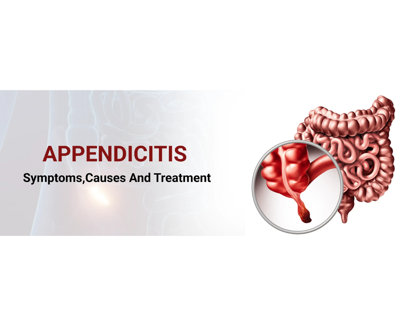 Appendicitis : symptoms, causes & treatment