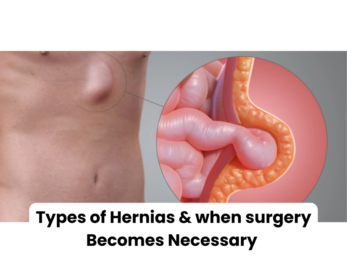 Types of Hernias & when surgery Becomes Necessary