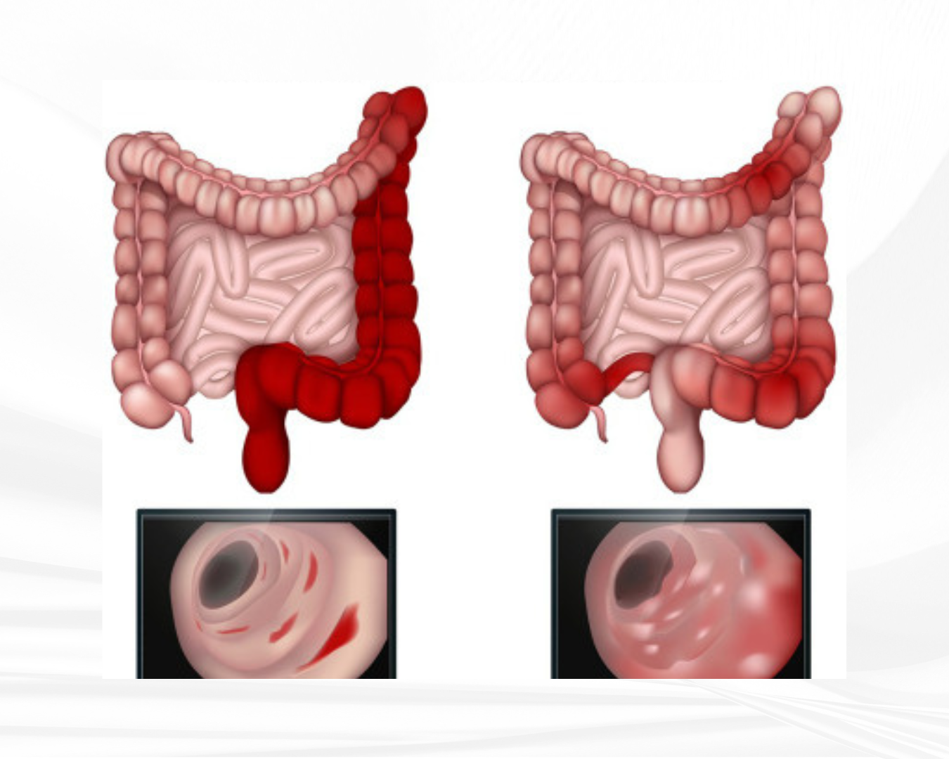 Complete Guide to Inflammatory Bowel Disease (IBD): Causes, Symptoms, Diagnosis &amp; Treatment