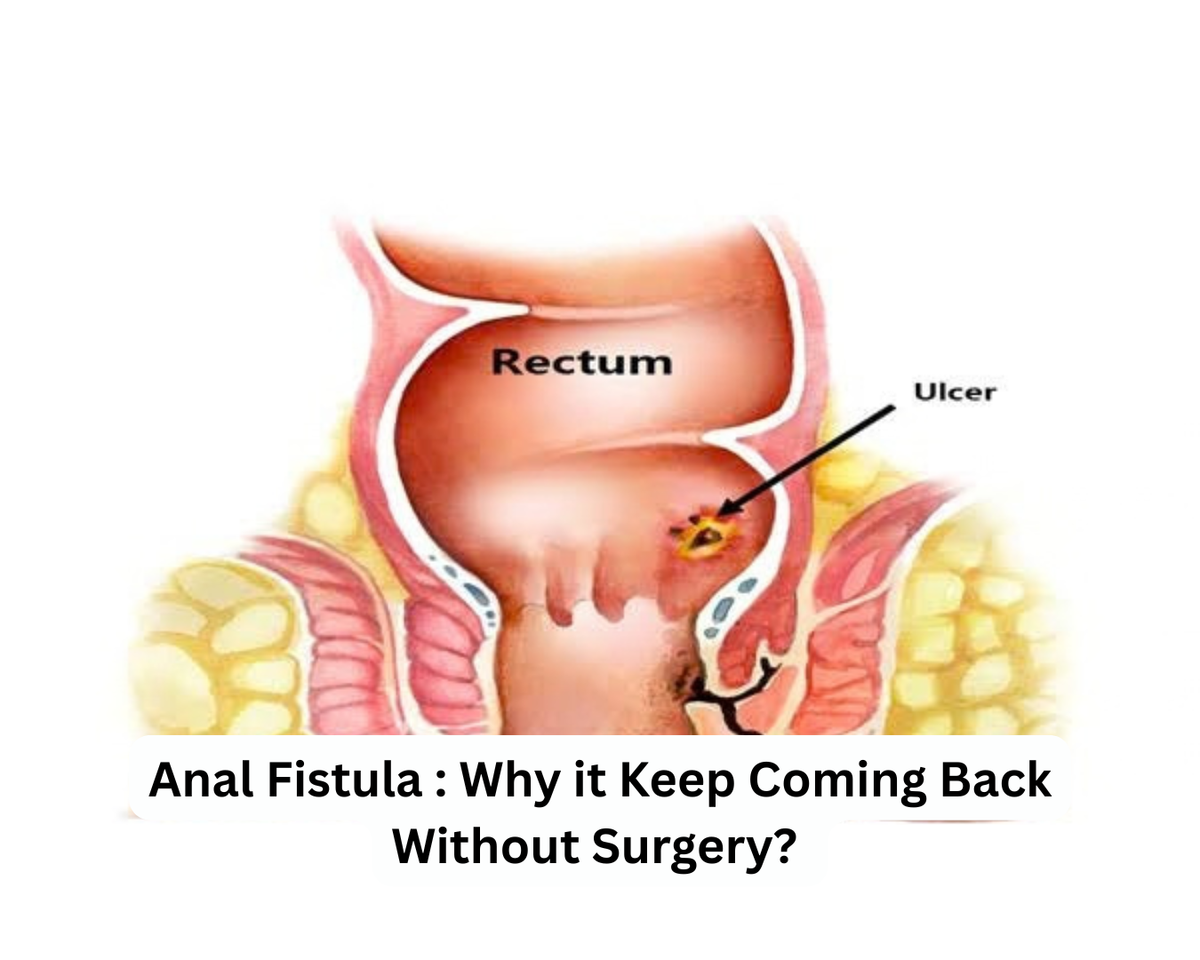 Anal Fistula : Why it Keep Coming Back Without Surgery?