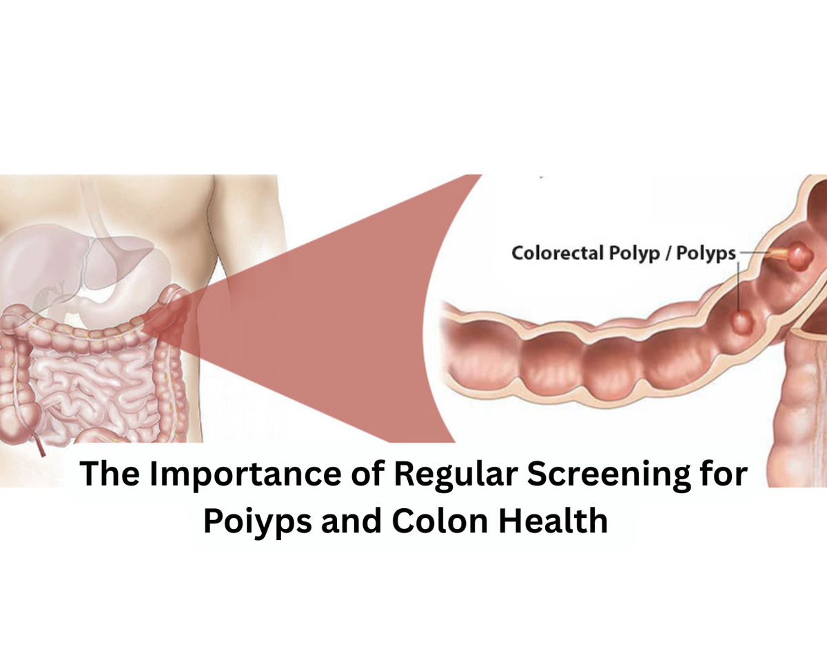 The Importance of Regular Screening for Poiyps and Colon Health