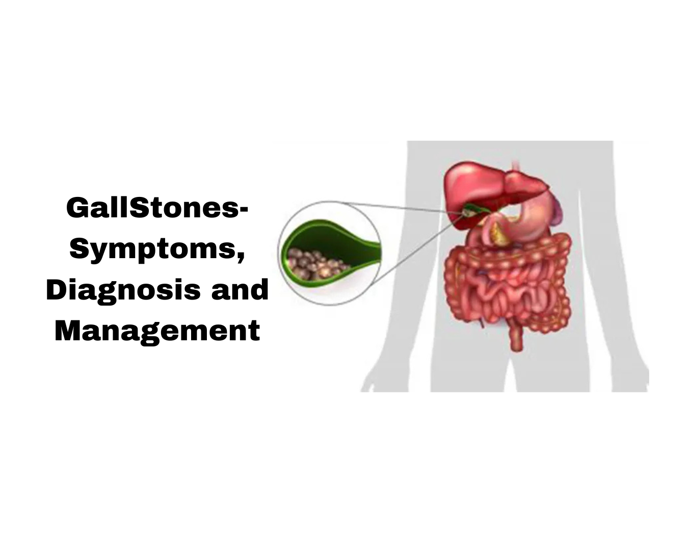 Gallstones: Symptoms, Causes, Diagnosis, Treatment, and Prevention