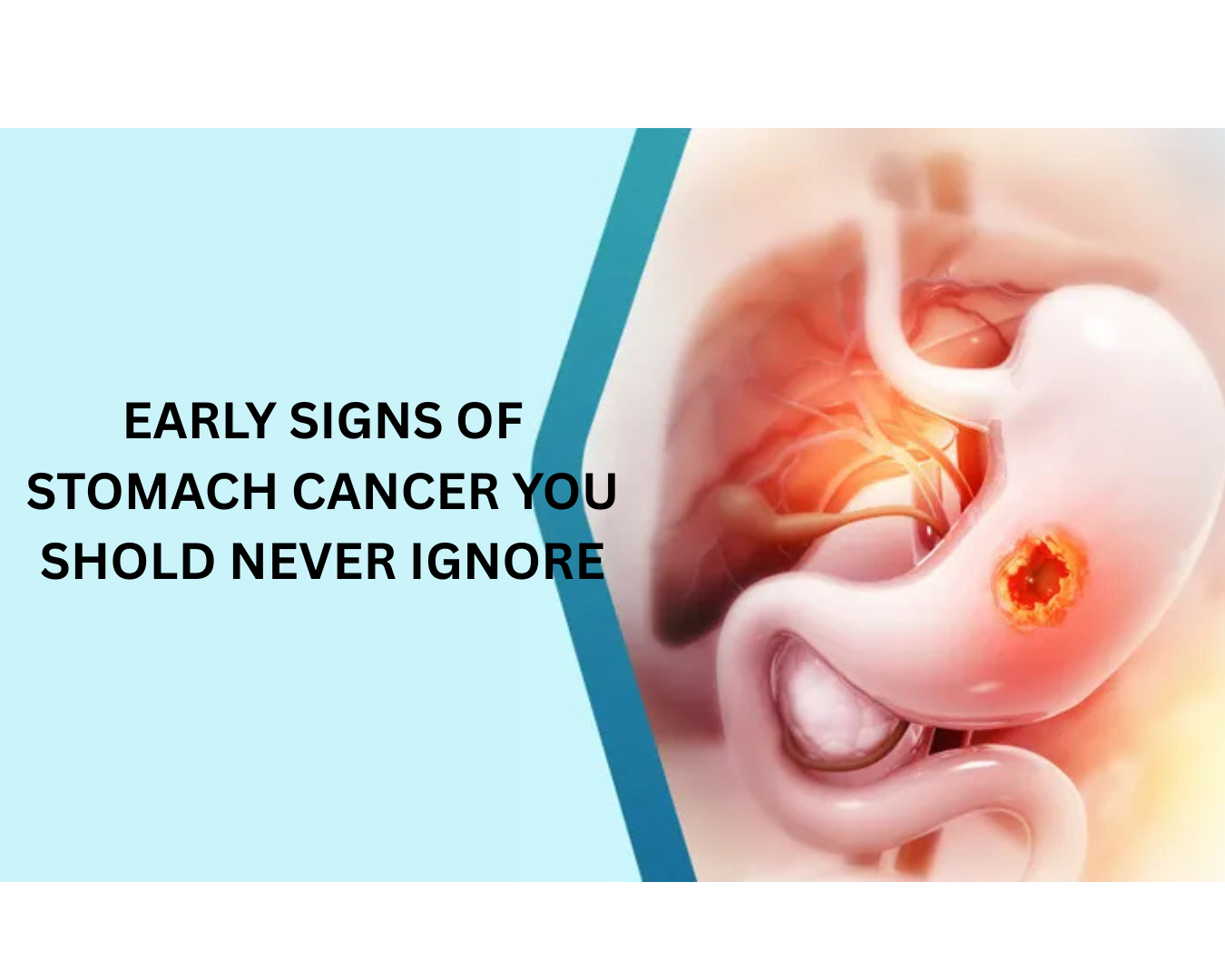 WHAT ARE THE EARLY SIGNS OF STOMACH CANCER? A COLORECTAL SURGEON IN SURAT EXPLAINS