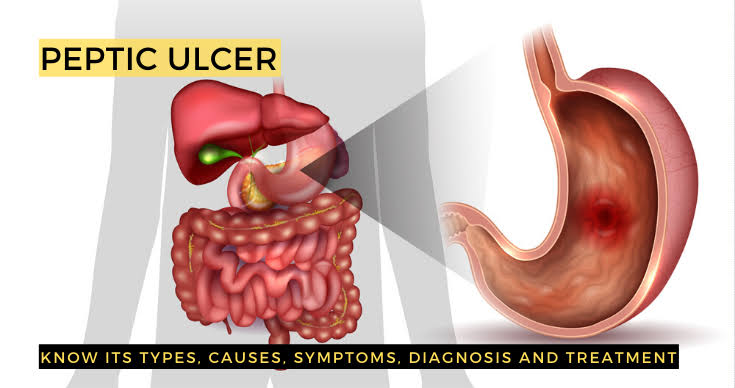 Peptic Ulcers: Signs , Causes ,and what you can do.
